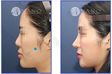 韩国鼻子修复出了名的医生有哪些?做鼻子厉害的医生都在哪?
