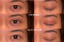 去日本割双眼皮多少钱?日本割双眼皮医院排名榜及价格揭秘!