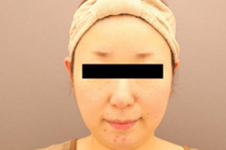 到日本去做面部吸脂经历分享，脸部抽脂这几点和国内不同!