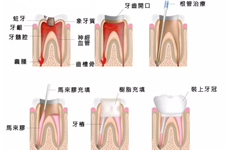 不要隨便做根管治療？揭秘寧愿拔牙不做根管治療對不對！