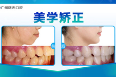 广州哪里矫正牙齿比较好？分享几家戴牙套比较好的医院！