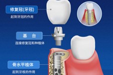 正規(guī)種牙一顆需要多少錢(qián)？便宜的種植牙多少錢(qián)一個(gè)？