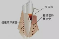 不要隨便做齦下刮治？為什么牙齒刮治做了后悔死了！