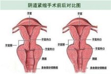 ﻿做完紧缩术好后悔？做完紧缩术的我来说说真实感受！