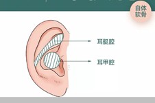 耳软骨隆鼻可以维持多久,一辈子吗？能维持几年看这几点！