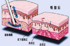 抽脂肪對(duì)身體有什么危害嗎？看完這幾點(diǎn)你就能避坑！