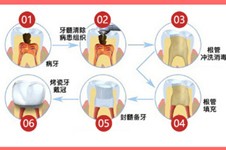 根管治疗后悔一辈子？牙齿烂洞长期不补真的会后悔！