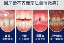 学生牙齿矫正箍牙齿多少钱?13岁,14岁,15岁,16岁戴牙套多少钱?