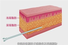 水動(dòng)力環(huán)吸和普通抽脂有什么區(qū)別?這幾點(diǎn)本質(zhì)差別你要知道!