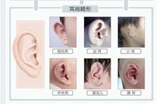 耳朵整形费用大概多少?耳朵畸形整形价格根据情况收费不同!