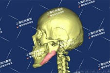 人工骨修復下頜角的醫(yī)生當中這三位醫(yī)生特別值得推薦！