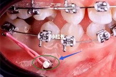 矫正牙齿骨钉可以做核磁吗?正畸打骨钉后注意事项要清楚！