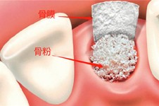 植骨和種植牙可以同時(shí)進(jìn)行嗎,有人牙齦植入骨粉很后悔!