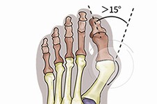 大脚骨手术过程图解,拇外翻手术年龄及恢复时间都有介绍！