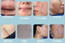 上海疤痕修复价目表2022,揭秘上海祛疤痕手术多少钱！