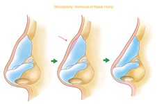 上海做鼻子好的醫(yī)生推薦榜，哪個醫(yī)生做得好一目了然！