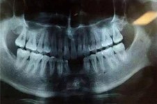 先天性恒牙缺失是什么原因造成的?天生恒牙缺失的原因公开!