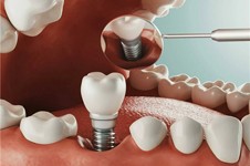 2022医院牙科收费价目表更新,种植牙和牙齿矫正收费标准都有
