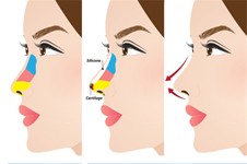 鼻子做得太低太自然了可以免费修复吗?原因技巧都告诉你!
