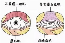 杜园园双眼皮改成单眼皮好吗?上海杜园园眼部日记惊艳!