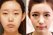 韩式切开法双眼皮手术费用大概是多少？