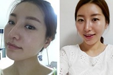 真人手术案例告诉你韩国驼峰鼻手术怎么做！