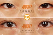 韩国双眼皮分为几种类型？ 手术方式和优缺点都有哪些？
