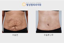 韩国腹壁成形术多少钱?附迷你腹壁整形和腹壁成型价格表!