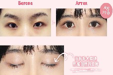 韩国现代美学整形做眼睛怎么样,多少钱?金虎医生眼修复好!