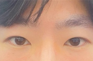 韩国EH爱护整形做提肌矫正和双眼皮出名,真人例子分享!
