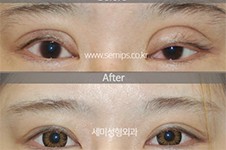 韩国世美semi整形朴相炫眼修复出名,是韩国高难度眼修复医生
