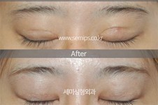 韩国修复双眼皮厉害的医生世美整形朴相炫入围眼修复前十!