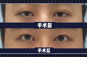 韩国来丽整形用案例说明双眼皮改单眼皮手术的优缺点！