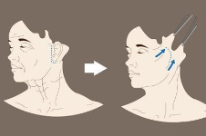 韩国可大丽整形外科很出名,金炫澈医生做拉皮手术/眼鼻整形技术好!