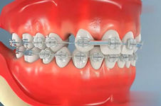 襄阳牙齿矫正哪里做的好？牙齿矫正需要多长时间