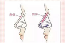 广州隆鼻哪家医院做的好?初次隆鼻不建议肋骨的原因是什么