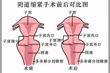 广州私密整形医生推荐，广州缩阴手术费用多少