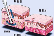 廣州哪家醫(yī)院能做吸脂5G天使光雕？效果怎么樣？