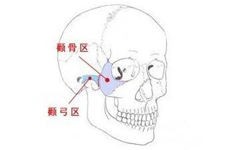 广州颧骨手术哪家医院好?颧骨颧弓内推手术案例分享