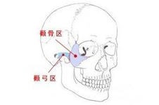 广州颧骨手术哪家医院好?颧骨颧弓内推手术日记分享