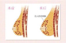 濟南自體脂肪隆胸到哪里好？脂肪隆胸能維持多久