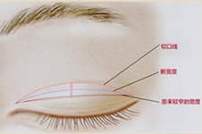寧波雙眼皮修復大概多少錢？哪家醫(yī)院做的好