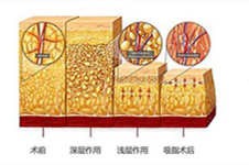 廣州吸脂多少錢一次？過來人告訴你這幾家吸脂醫(yī)院好