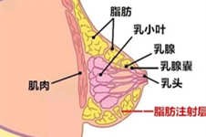 济南自体脂肪填充哪家好？脂肪丰胸填充一次多少钱