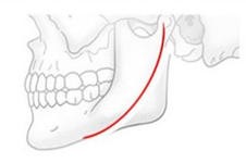 贵阳磨骨手术去哪家做好?下颌角磨骨多少钱价格高不高