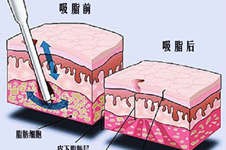 在铜仁做吸脂去哪个医院正规?有人去过这几家做吸脂吗