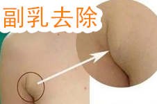 贵阳副乳切除手术大概需要多少钱?哪家医院做副乳去除手术