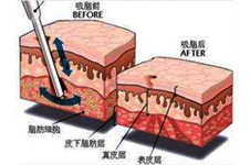 贵阳可以抽脂的正规医院有哪些？抽脂哪家医院比较好的呢