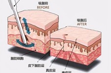 贵阳腰腹吸脂价格一般是多少？腰腹环吸是那几个部位？