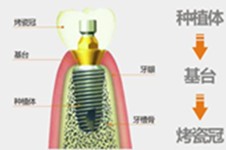 贵阳种植牙好一点的牙科医院有哪些?当地市民种植牙就选这